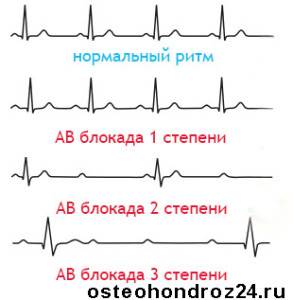 блокада сердца на экг