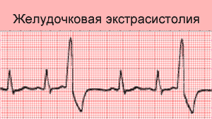желудочковая экстрасистолия экг