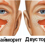 Гайморит у взрослых