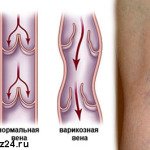 варикоз