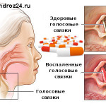 связки при ларингите